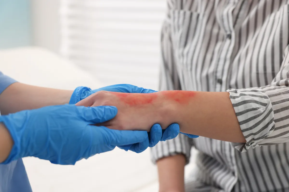 Profissional de saúde usando luvas azuis examinando queimadura avermelhada no braço de uma pessoa.